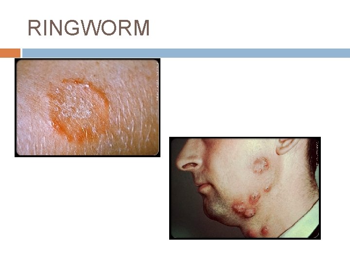 RINGWORM 