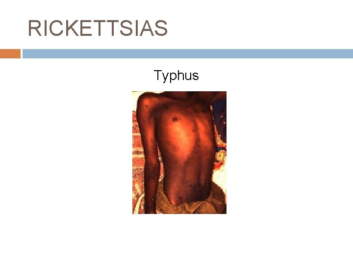 RICKETTSIAS Typhus 