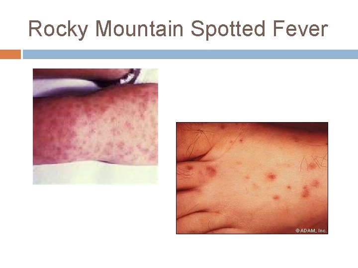 Rocky Mountain Spotted Fever 