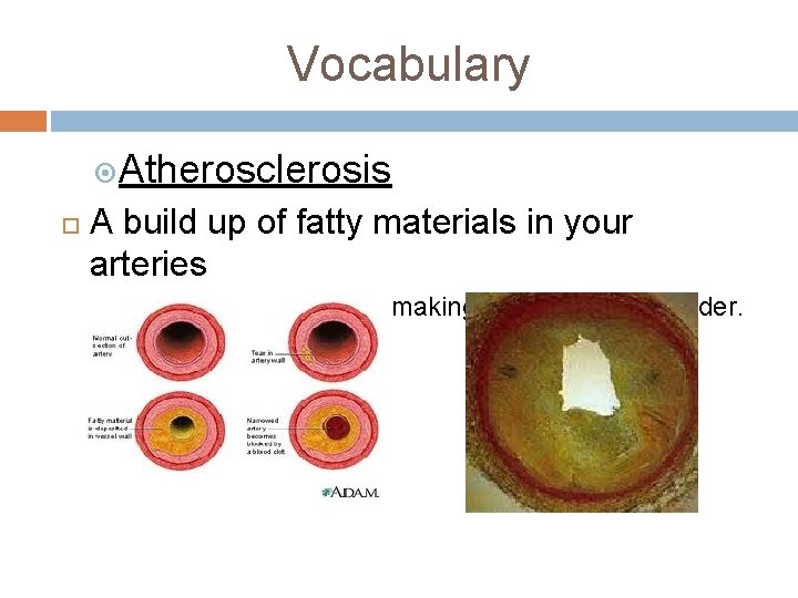 Vocabulary Atherosclerosis A build up of fatty materials in your arteries narrows the arteries,