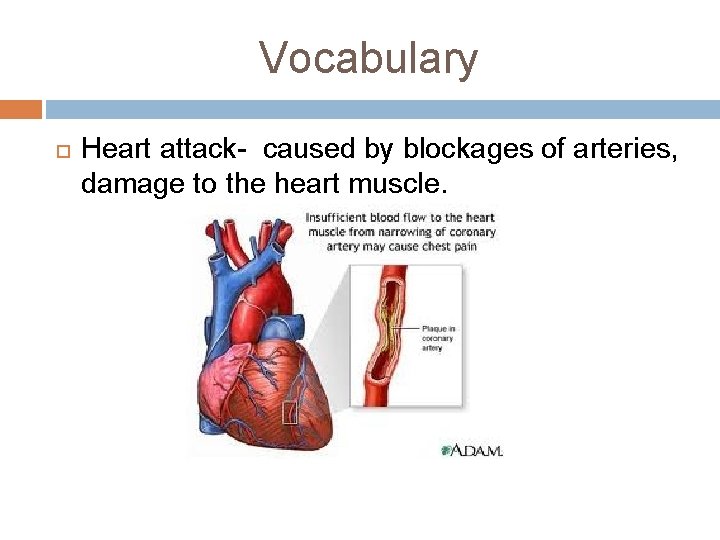 Vocabulary Heart attack- caused by blockages of arteries, damage to the heart muscle. 