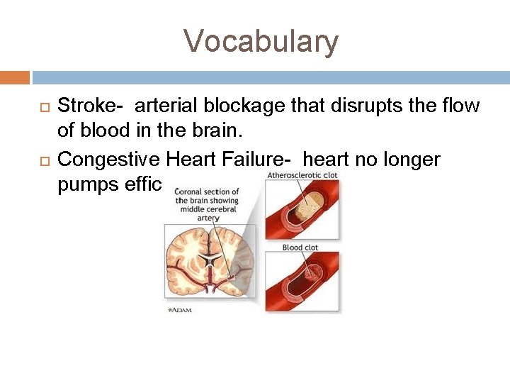 Vocabulary Stroke- arterial blockage that disrupts the flow of blood in the brain. Congestive