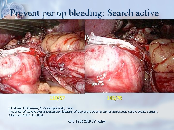 Prevent per op bleeding: Search active 110/57 145/78 J. P. Mulier, B Dillemans, G