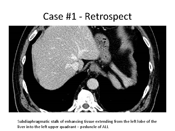 Case #1 - Retrospect Subdiaphragmatic stalk of enhancing tissue extending from the left lobe