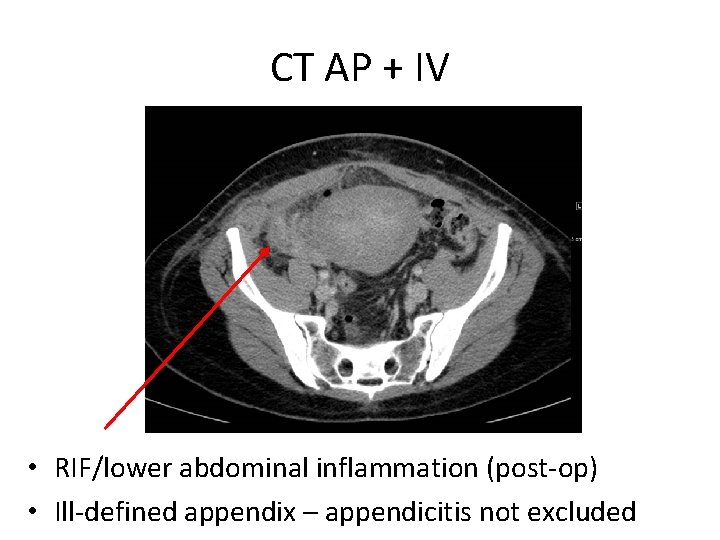 CT AP + IV • RIF/lower abdominal inflammation (post-op) • Ill-defined appendix – appendicitis