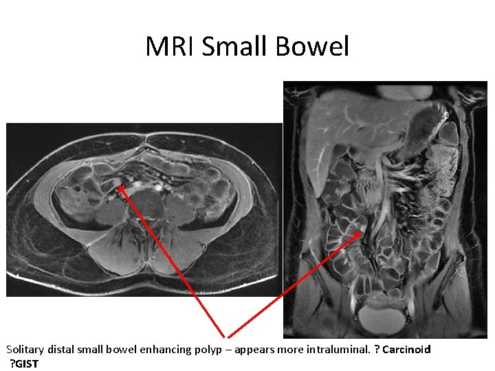 MRI Small Bowel Solitary distal small bowel enhancing polyp – appears more intraluminal. ?