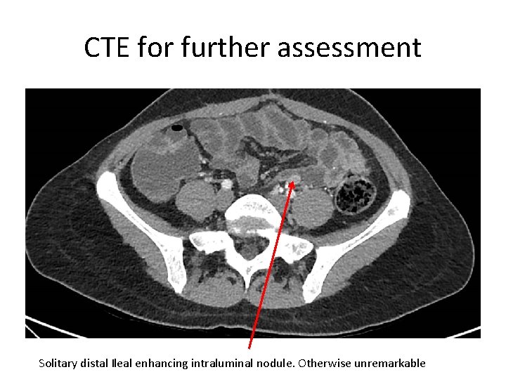 CTE for further assessment Solitary distal Ileal enhancing intraluminal nodule. Otherwise unremarkable 