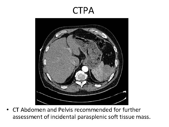 CTPA • CT Abdomen and Pelvis recommended for further assessment of incidental parasplenic soft
