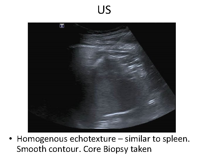 US • Homogenous echotexture – similar to spleen. Smooth contour. Core Biopsy taken 