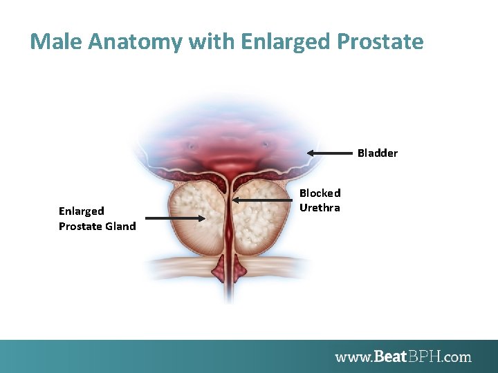 Male Anatomy with Enlarged Prostate Bladder Enlarged Prostate Gland Blocked Urethra 