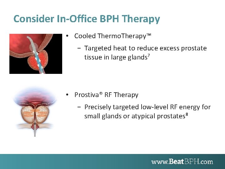 Consider In-Office BPH Therapy • Cooled Thermo. Therapy™ − Targeted heat to reduce excess