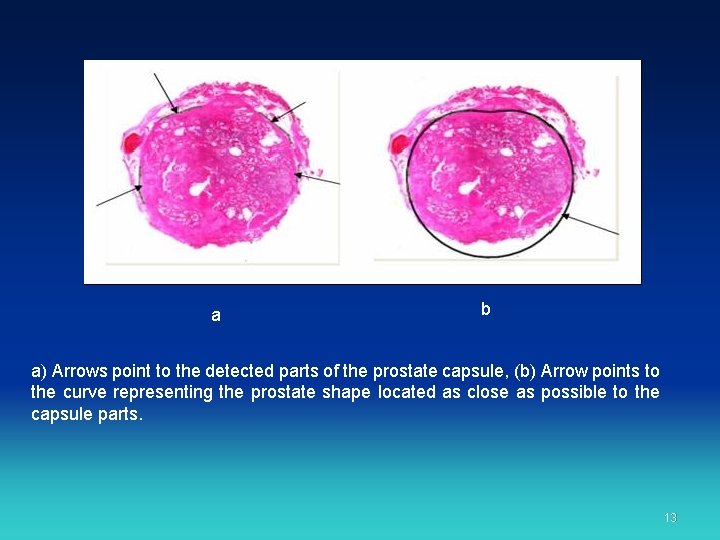 a b a) Arrows point to the detected parts of the prostate capsule, (b)