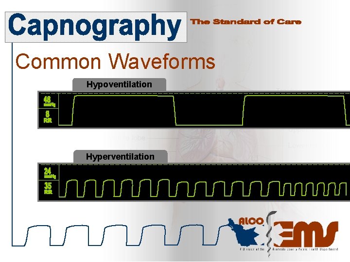 Common Waveforms Hypoventilation Hyperventilation 