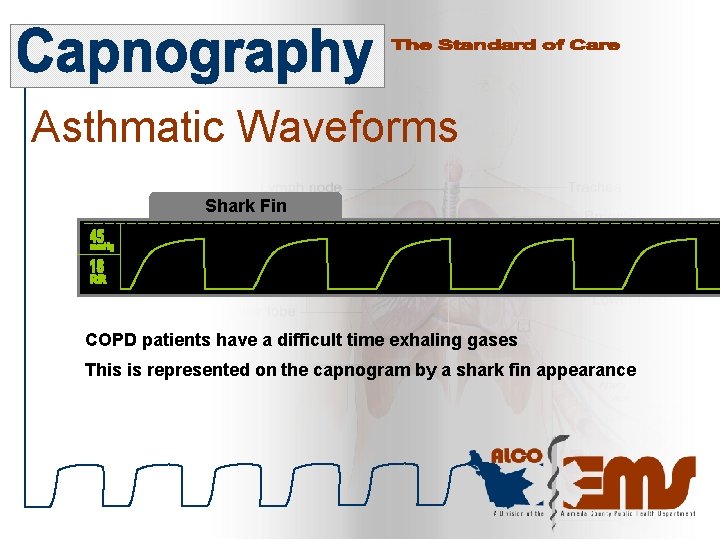 Asthmatic Waveforms Shark Fin COPD patients have a difficult time exhaling gases This is