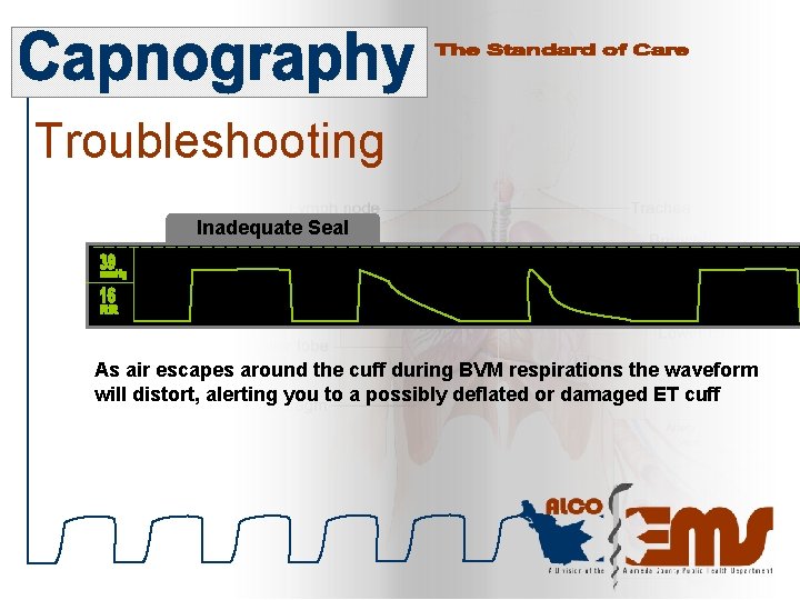 Troubleshooting Inadequate Seal As air escapes around the cuff during BVM respirations the waveform