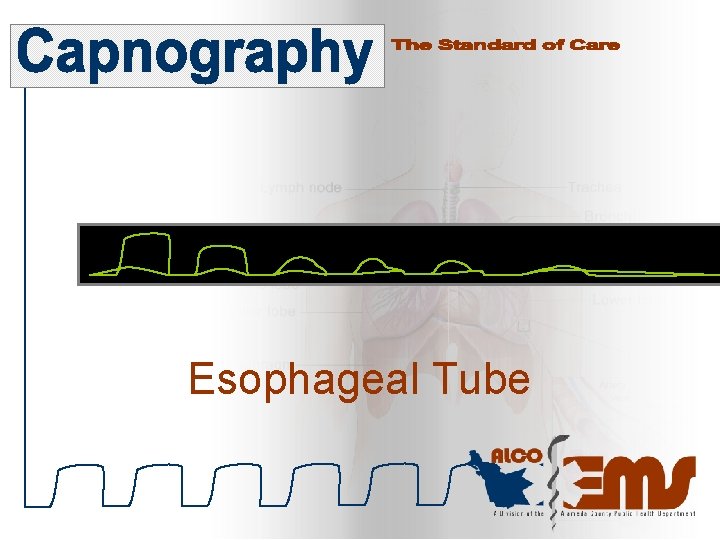 Esophageal Tube 