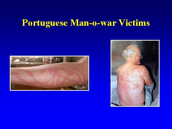 Portuguese Man-o-war Victims 
