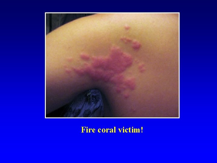 Fire coral victim! 