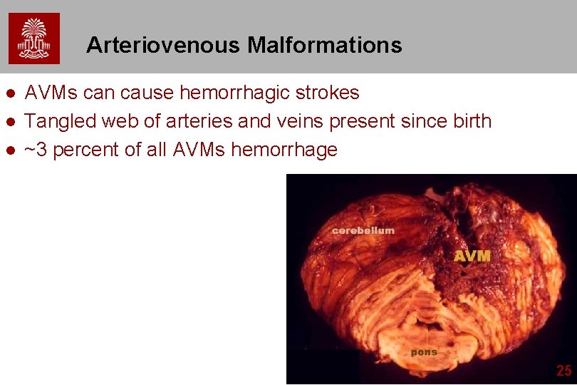 Arteriovenous Malformations l l l AVMs can cause hemorrhagic strokes Tangled web of arteries