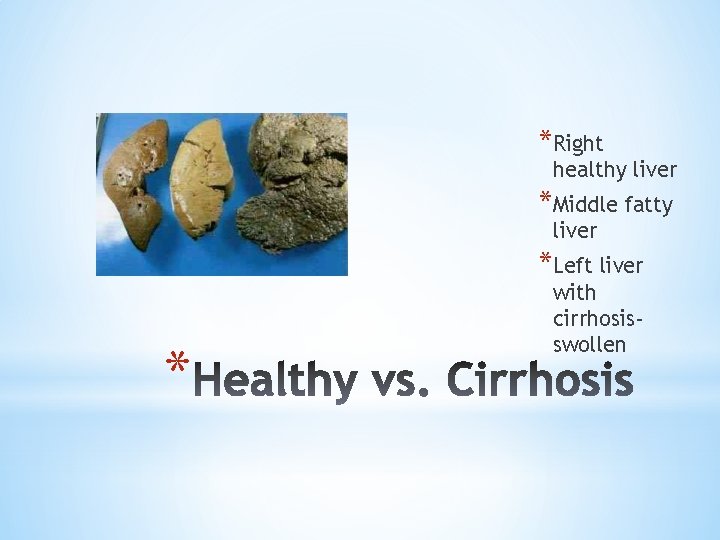 *Right healthy liver *Middle fatty liver *Left liver * with cirrhosisswollen 