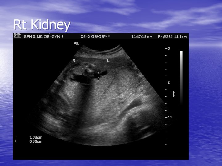 Rt Kidney 