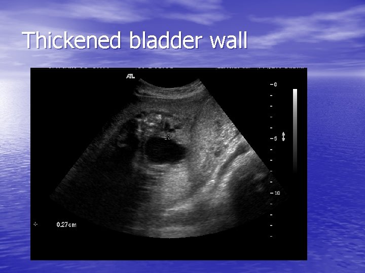 Thickened bladder wall 