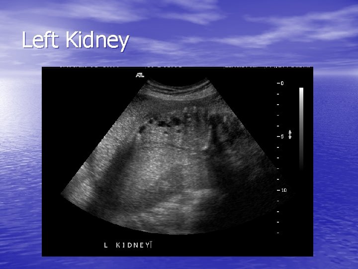 Left Kidney 