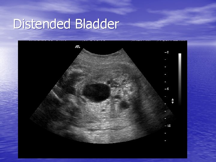 Distended Bladder 