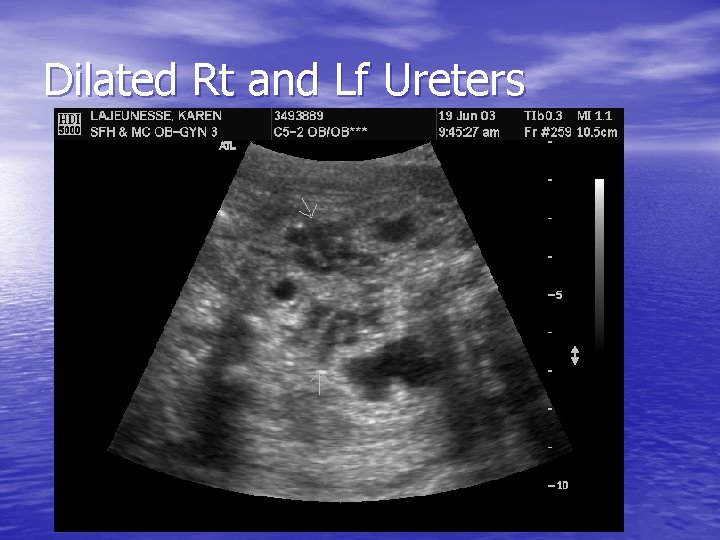 Dilated Rt and Lf Ureters 