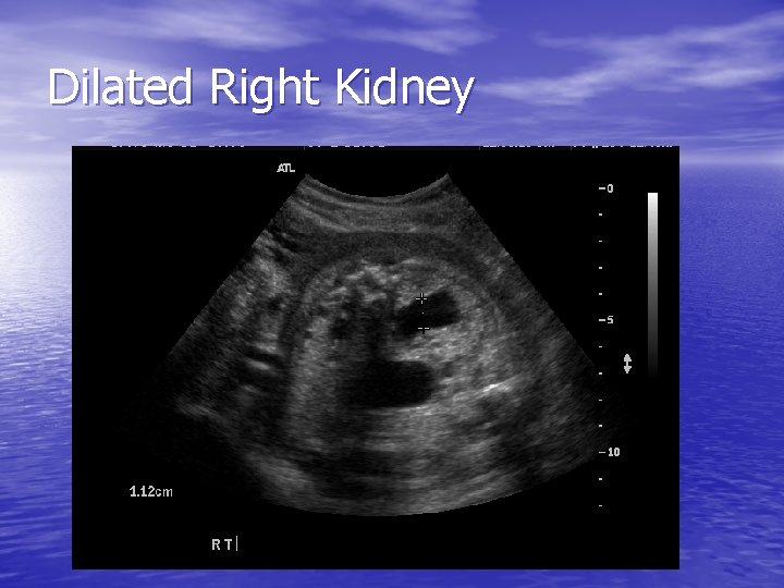 Dilated Right Kidney 