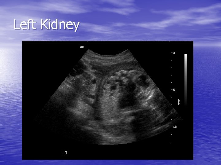 Left Kidney 