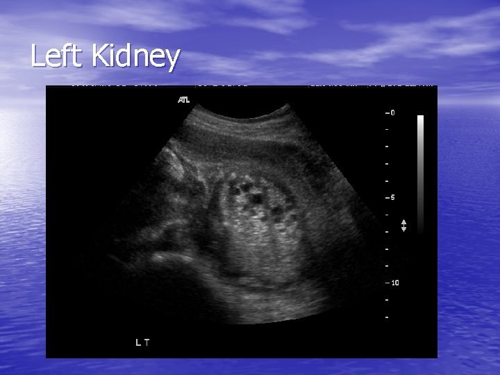 Left Kidney 