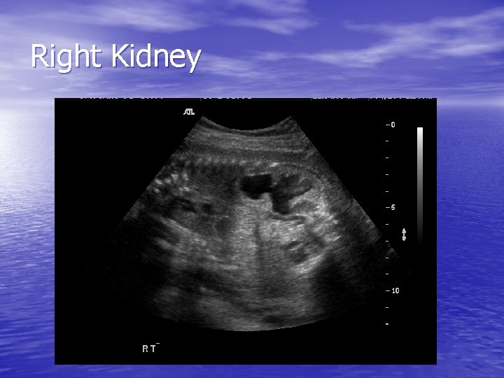 Right Kidney 