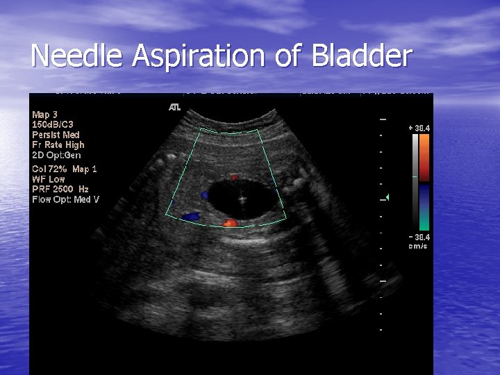 Needle Aspiration of Bladder 