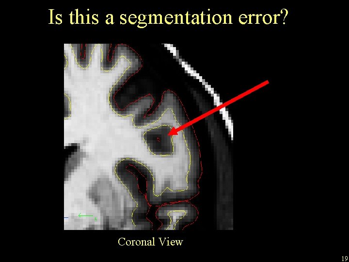 Is this a segmentation error? Coronal View 19 