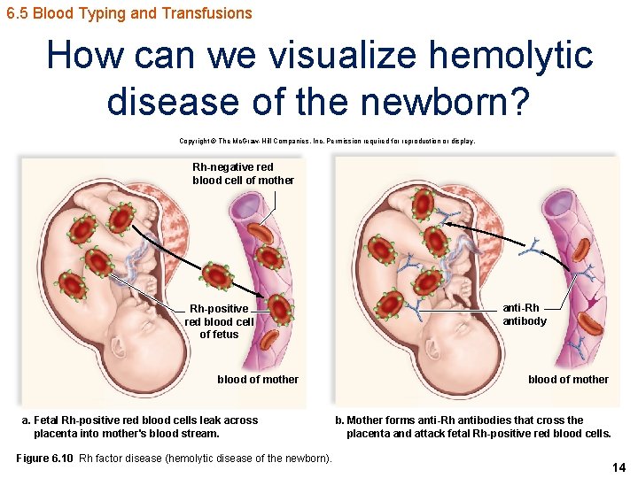 6. 5 Blood Typing and Transfusions How can we visualize hemolytic disease of the