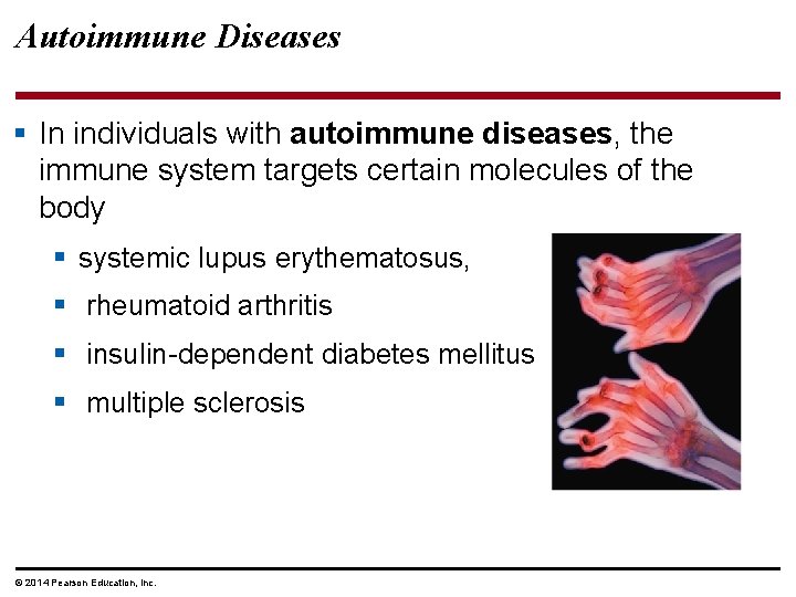 Autoimmune Diseases § In individuals with autoimmune diseases, the immune system targets certain molecules