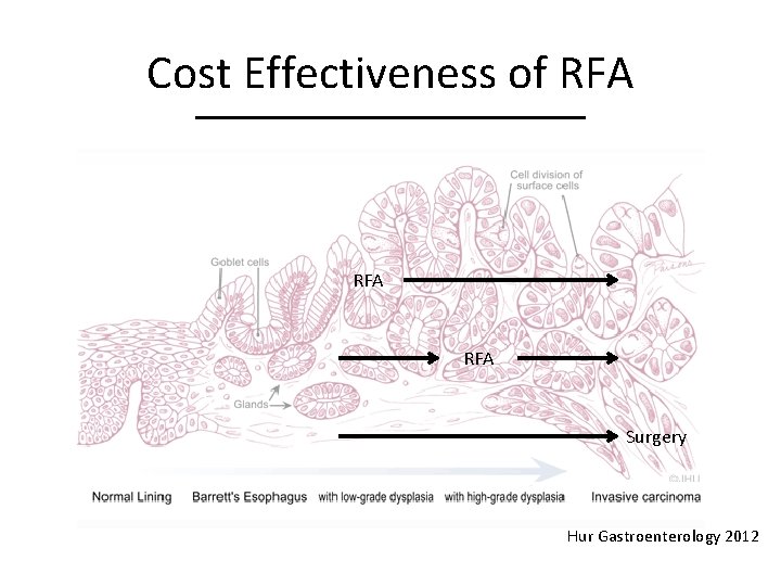 Cost Effectiveness of RFA RFA Surgery Hur Gastroenterology 2012 