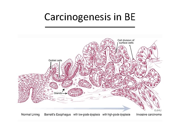 Carcinogenesis in BE 