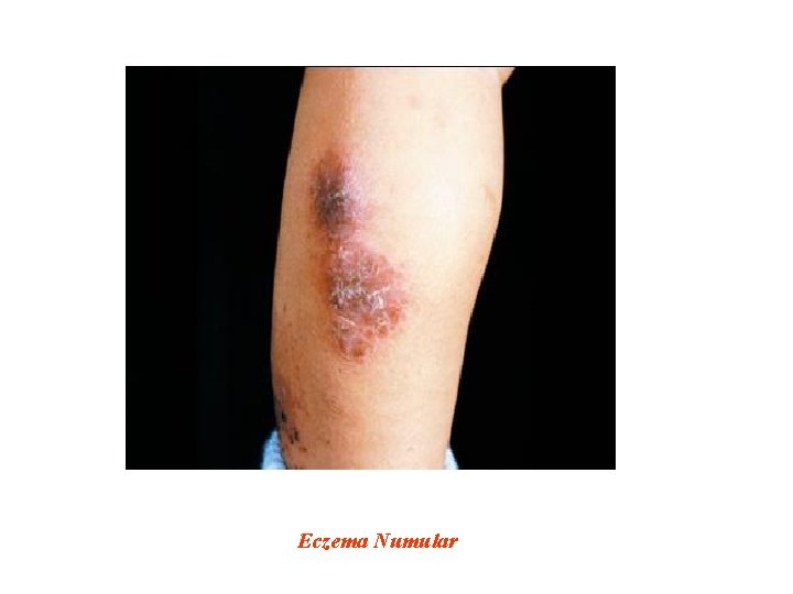 Eczema Numular 