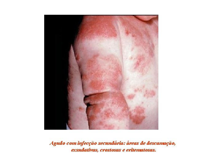 Agudo com infecção secundária: áreas de descamação, exsudativas, crostosas e eritematosas. 