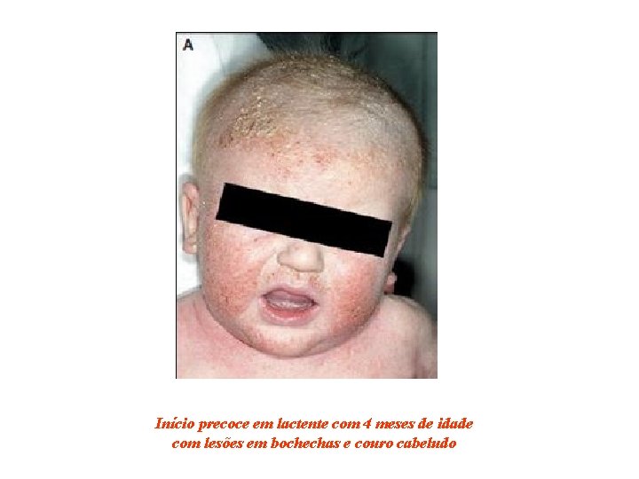 Início precoce em lactente com 4 meses de idade com lesões em bochechas e