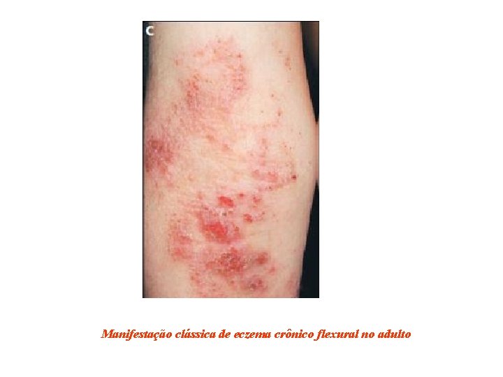 Manifestação clássica de eczema crônico flexural no adulto 