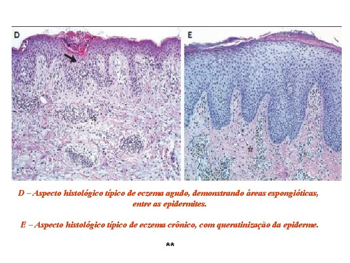 D – Aspecto histológico típico de eczema agudo, demonstrando áreas espongióticas, entre as epidermites.