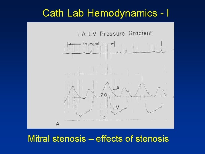 Cath Lab Hemodynamics - I Mitral stenosis – effects of stenosis 