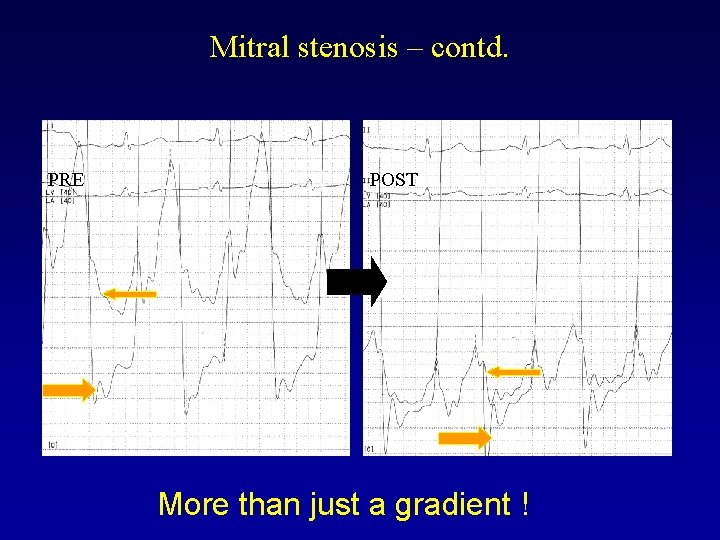 Mitral stenosis – contd. PRE POST More than just a gradient ! 