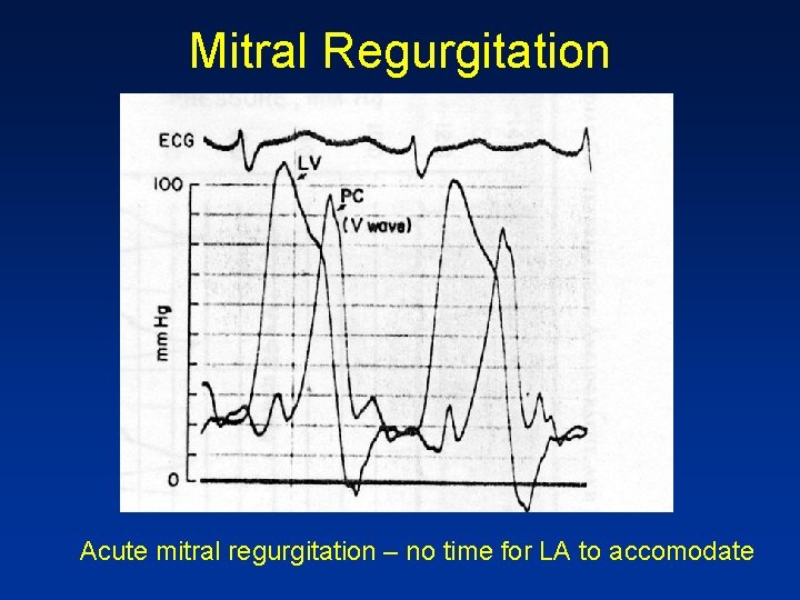 Mitral Regurgitation Acute mitral regurgitation – no time for LA to accomodate 