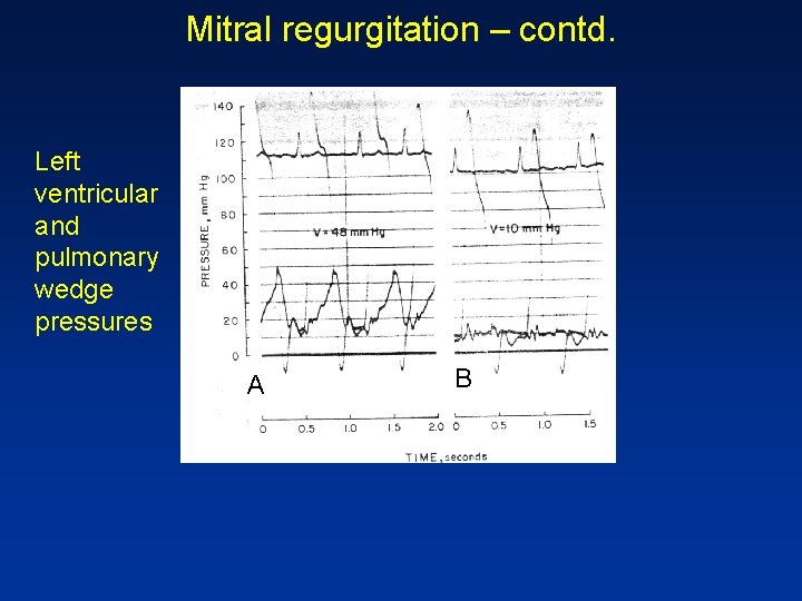 Mitral regurgitation – contd. Left ventricular and pulmonary wedge pressures A B 