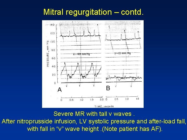 Mitral regurgitation – contd. A B Severe MR with tall v waves. After nitroprusside