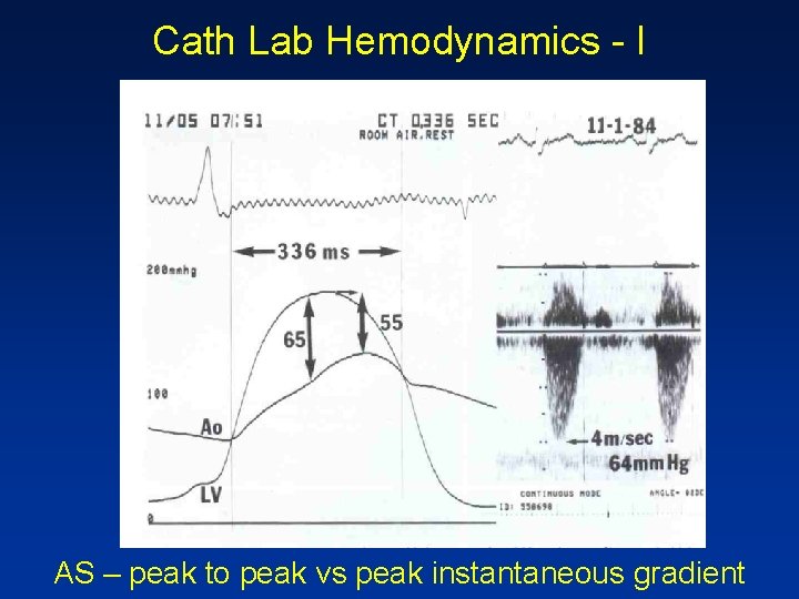 Cath Lab Hemodynamics - I AS – peak to peak vs peak instantaneous gradient